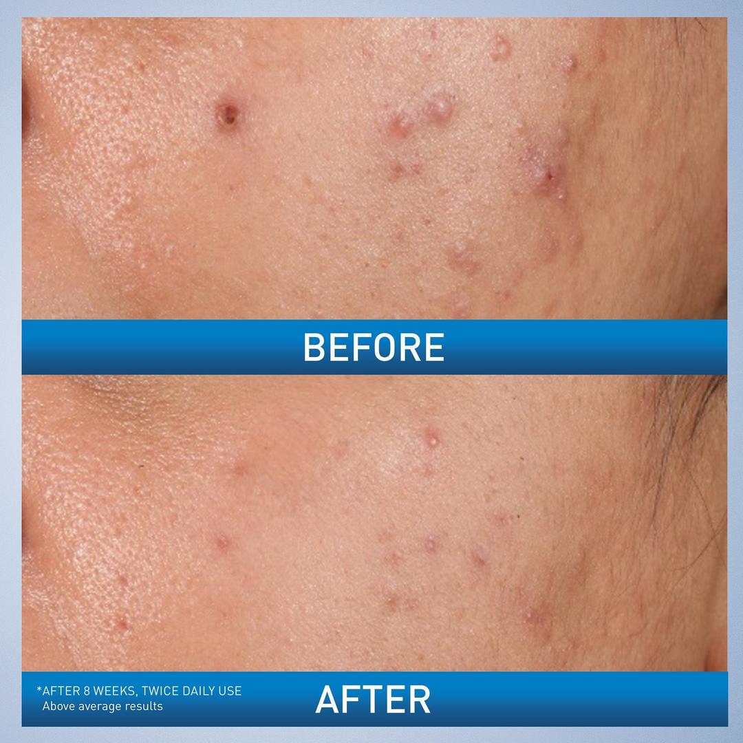 CeraVe Acne Control Gel Blemish Treatment