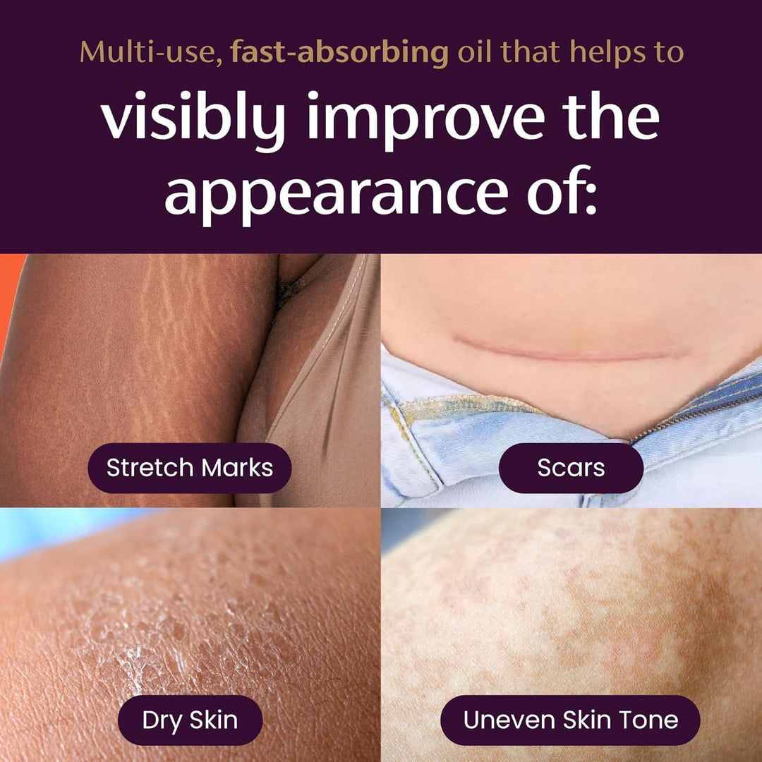 Mederma Quick Dry Oil Scar and Stretch Mark Treatment