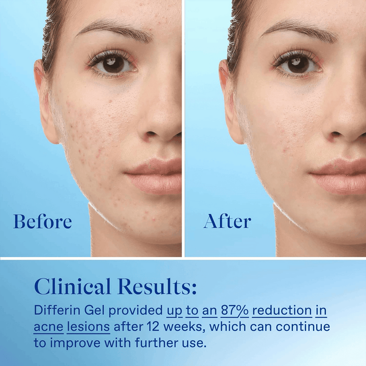 Differin - Adapaleen Gel 0,1% Acnebehandeling, Parfumvrij - 15 g