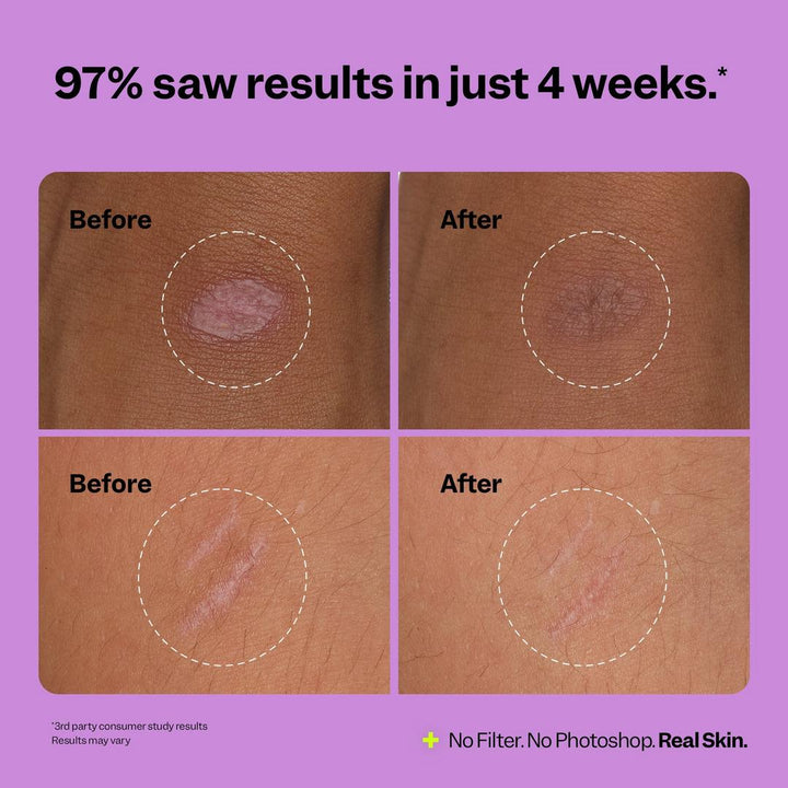 Peach Slices Scar Remedy Silicone Gel