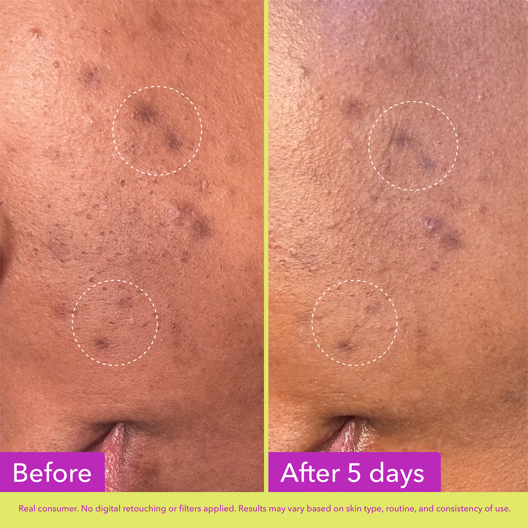 Good Molecules Dark Spot Microdart Patches