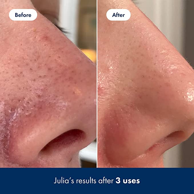 Hero Cosmetics - Pore Release, Blackhead Clearing Solution - 2% salicylzuur -  100 ml