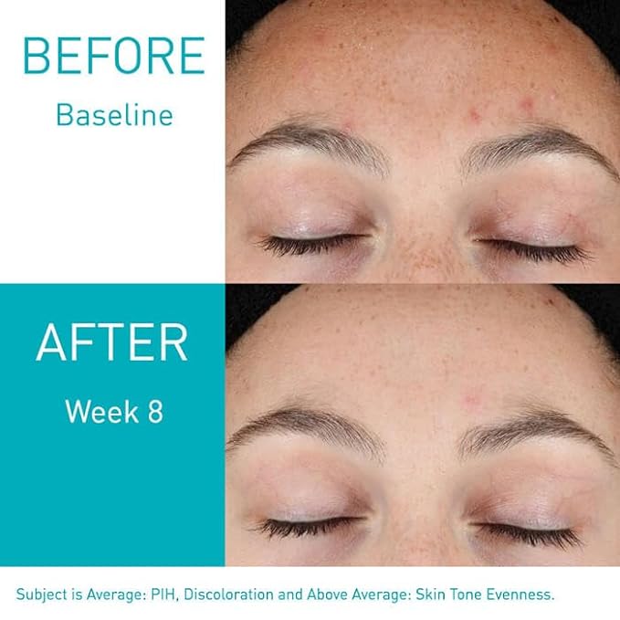 CeraVe - Retinolserum voor post-acnevlekken en huidtextuur - 30 ml
