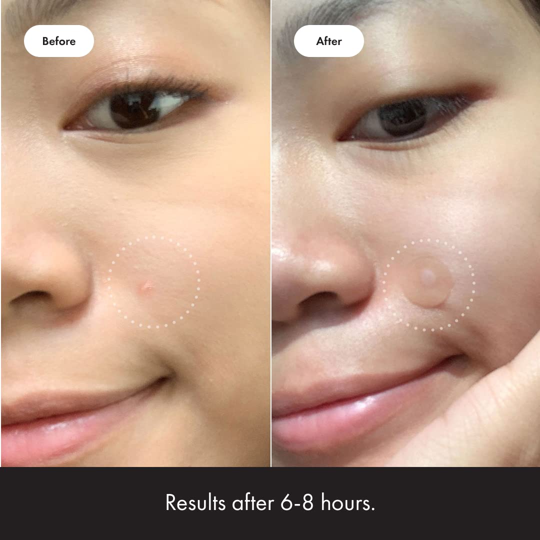 Hero Cosmetics - Mighty Patch Original Acne Pimple Patches - 72 pleisters