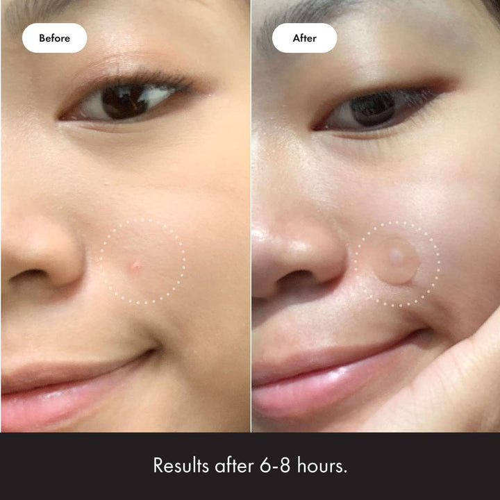 Hero Cosmetics - Mighty Patch Original Acne Pimple Patches - 72 pleisters