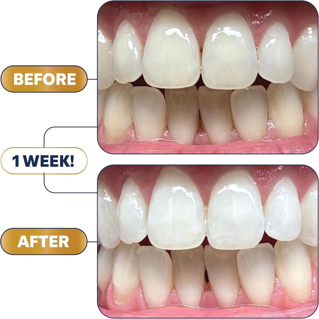 Lumineux Ultimate Whitening Kit Bundle