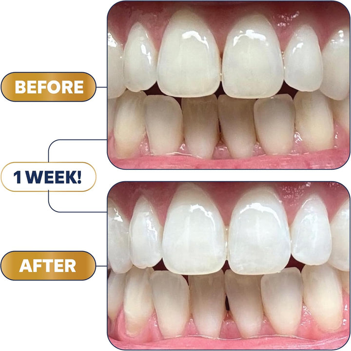 Lumineux Ultimate Whitening Kit Bundle