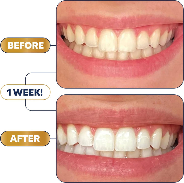 Lumineux Ultimate Whitening Kit Bundle
