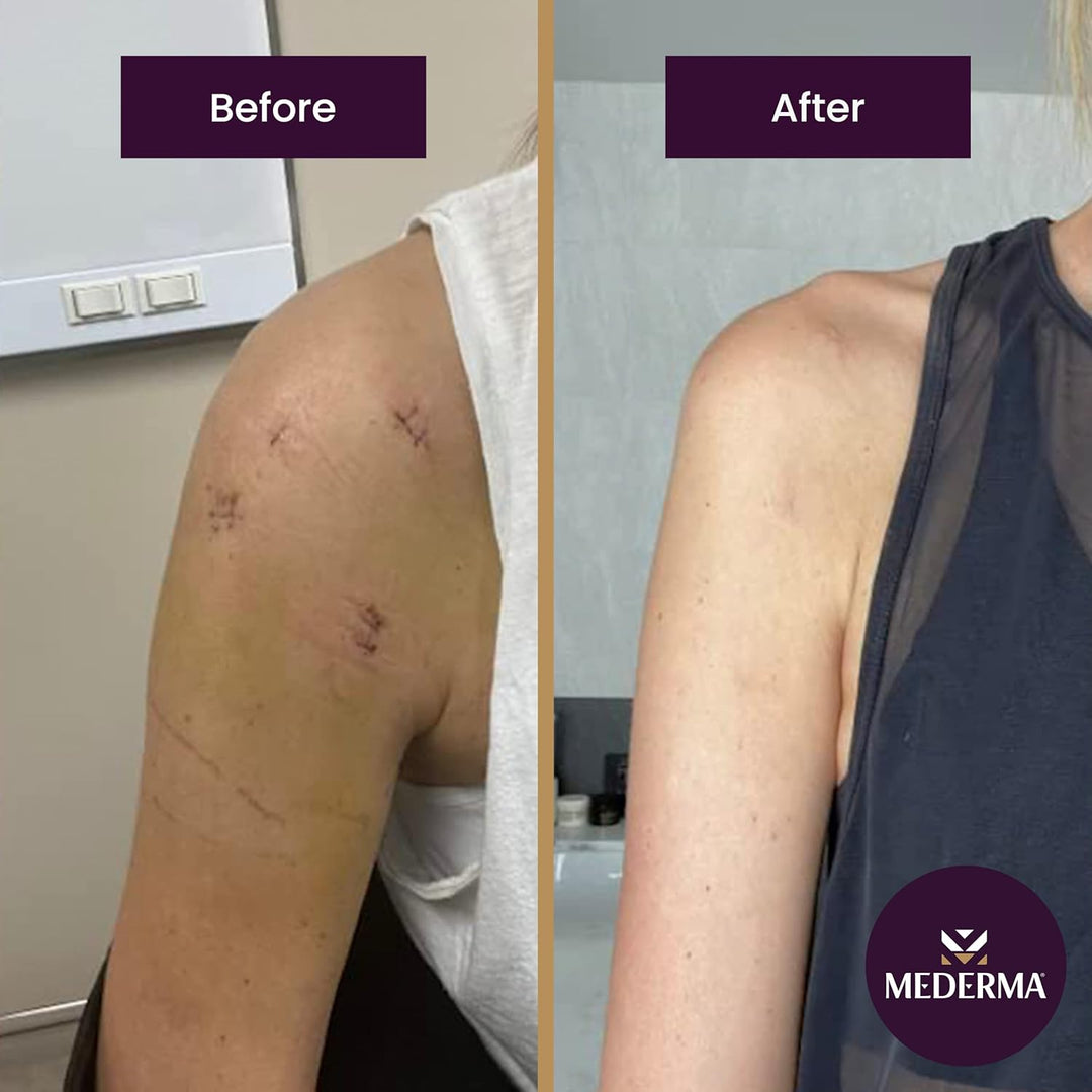 Mederma - Geavanceerde littekengel - Behandelt oude en nieuwe littekens - Vermindert het uiterlijk van littekens door acne