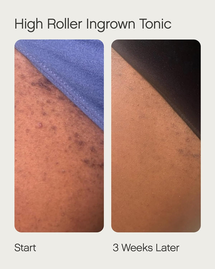 Topicals - Ingrown Duo - Faded Serum for Dark Spots and Discoloration