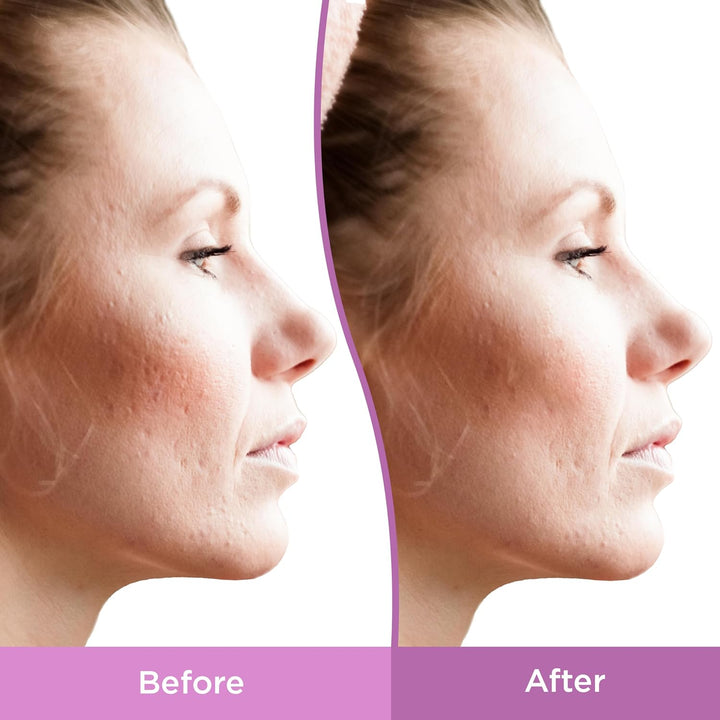 Differin Gel Acne Scar Spot Treatment for Face, Resurfacing Scar Gel Gentle Skin Care for Acne Prone Sensitive Skin - 30ml