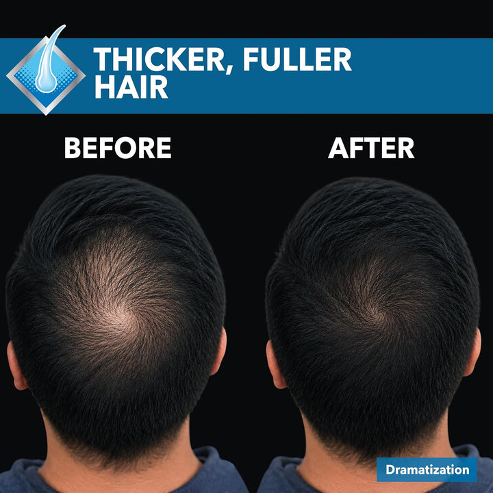 Nizoral Hair Regrowth Treatment for Men Minoxidil Topical Aerosol 5%, 3 Pk