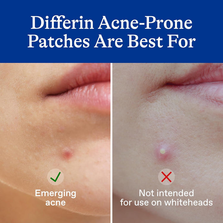 Differin Acne Prone Skin Patches
