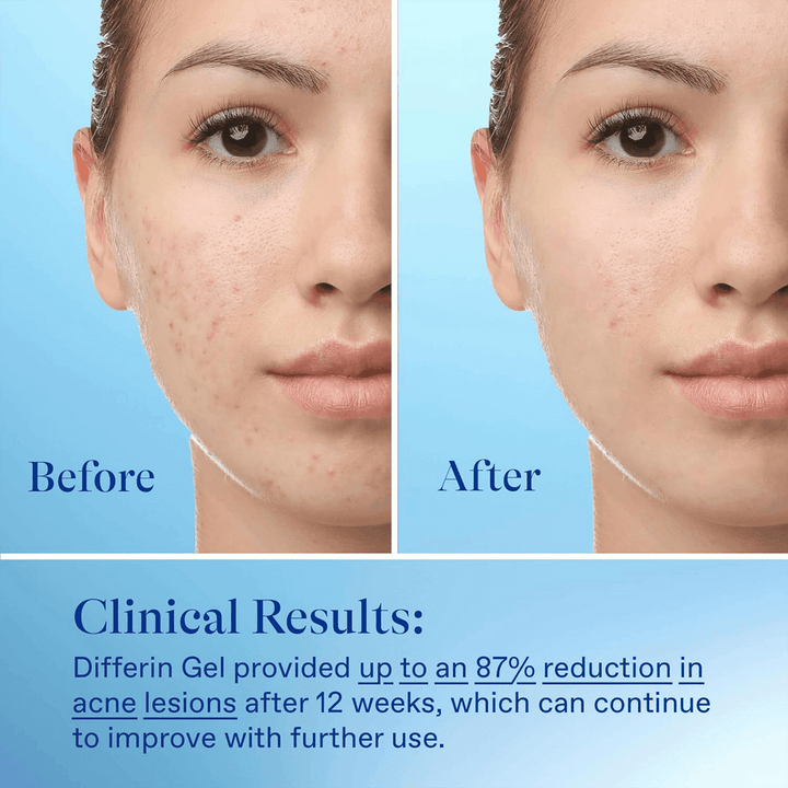 Differin - Adapalene Gel 0.1% Acne Treatment - 45 g