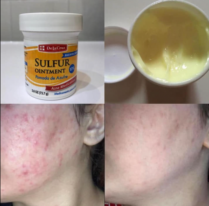 De La Cruz - Acne Treatment Ointment with 10% Sulfur, Maximum Strength - 6 g