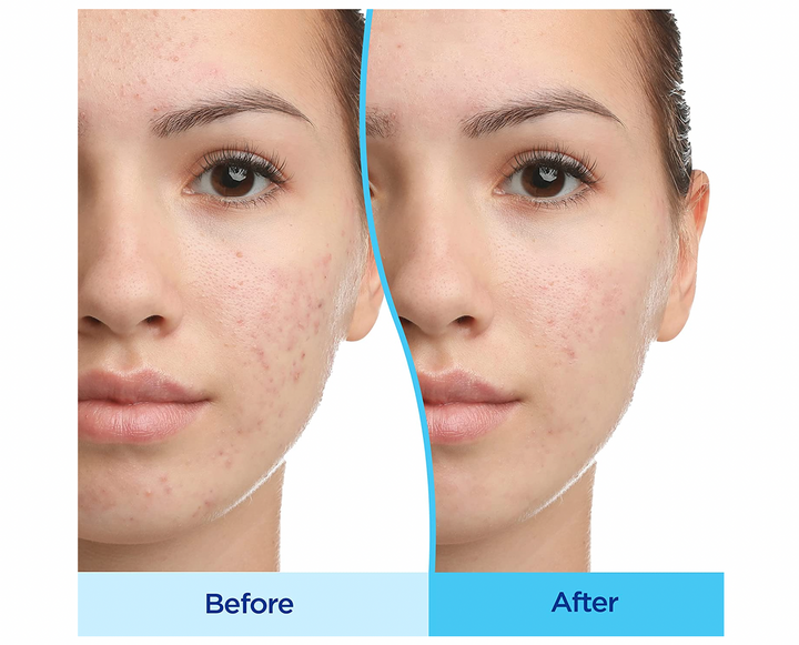 Differin - Adapalene Gel 0.1 % Acne Treatment - Fragrance Free - 15 g