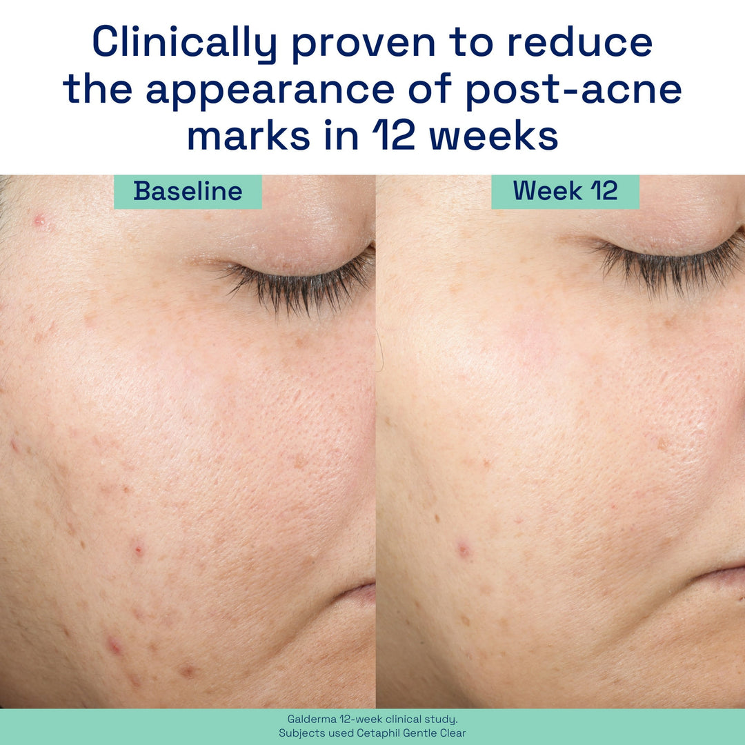 Cetaphil - Gentle Clear Repairing Post-Acne Serum - Retinol - Olievrij Serum - 30 ml