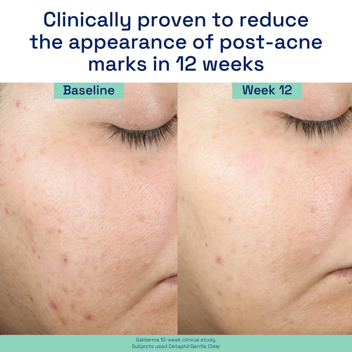 Cetaphil - Gentle Clear Repairing Post-Acne Serum - Retinol - Olievrij Serum - 30 ml